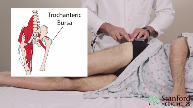 greater trochanteric bursitis